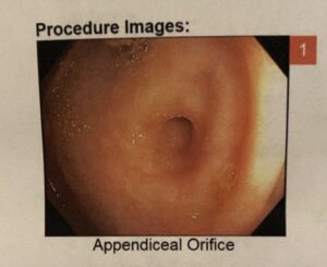 Appendiceal Orifice